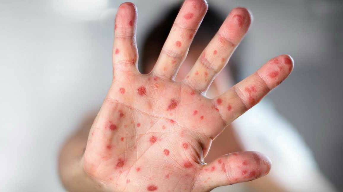 Symptoms of measles. Stock image